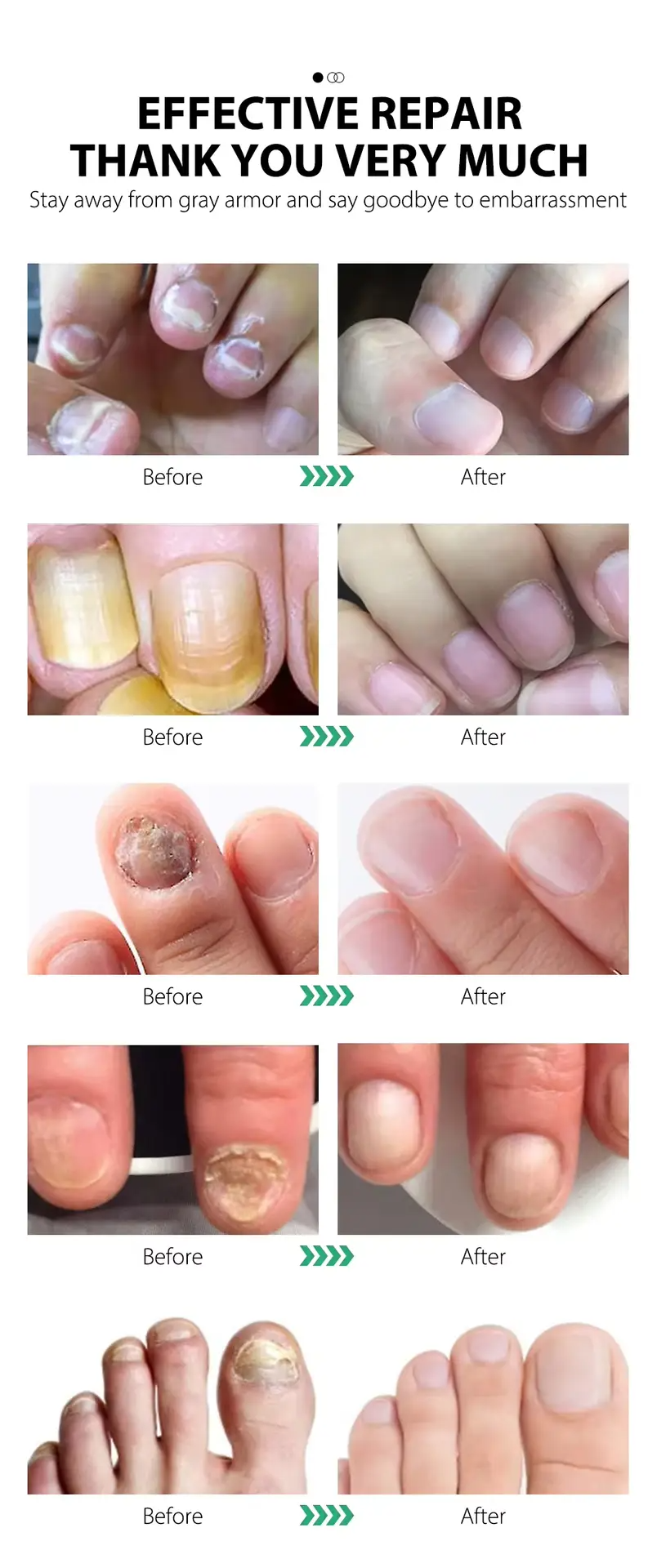 Best Nail Fungus Serum Price in Pakistan – 7 Day Treatment (30ml)